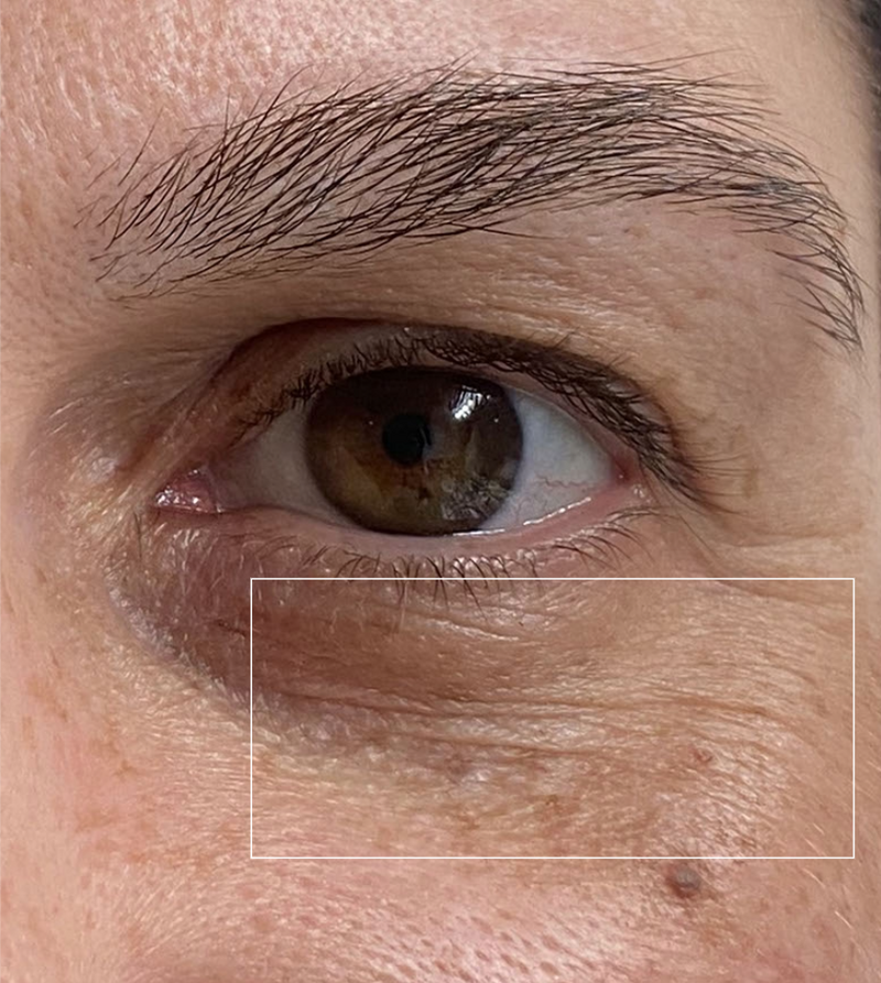 Before - Under-Eye Area