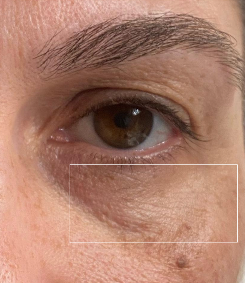 After - Under-Eye Area
