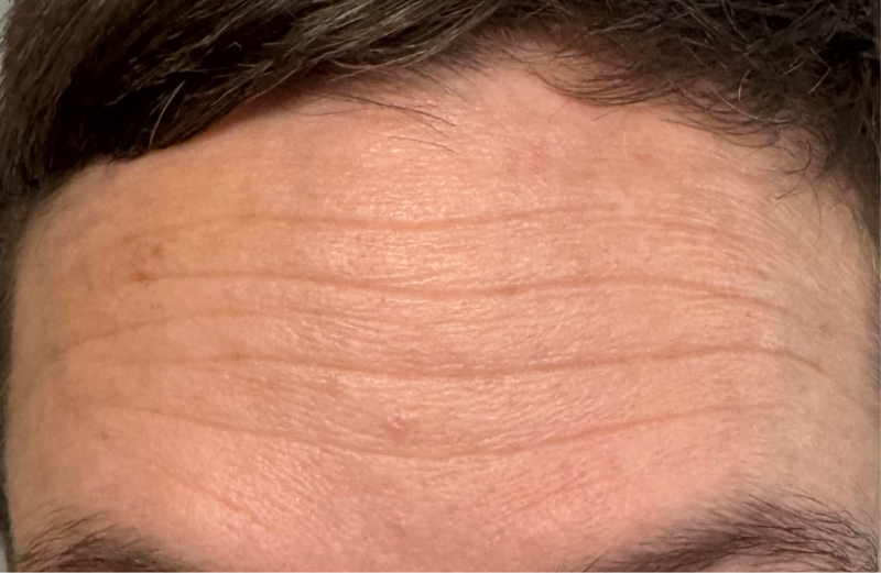 Before - Forehead Area