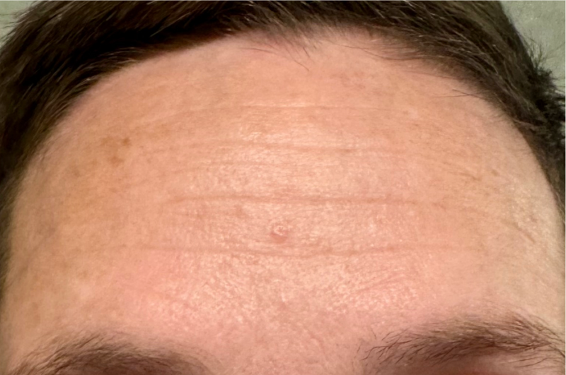 After - Forehead Area