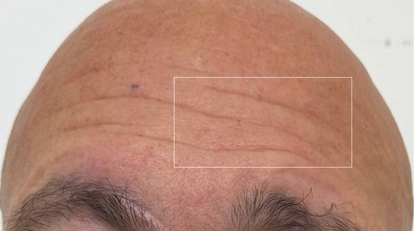 Before - Nasolabial Fold Area
