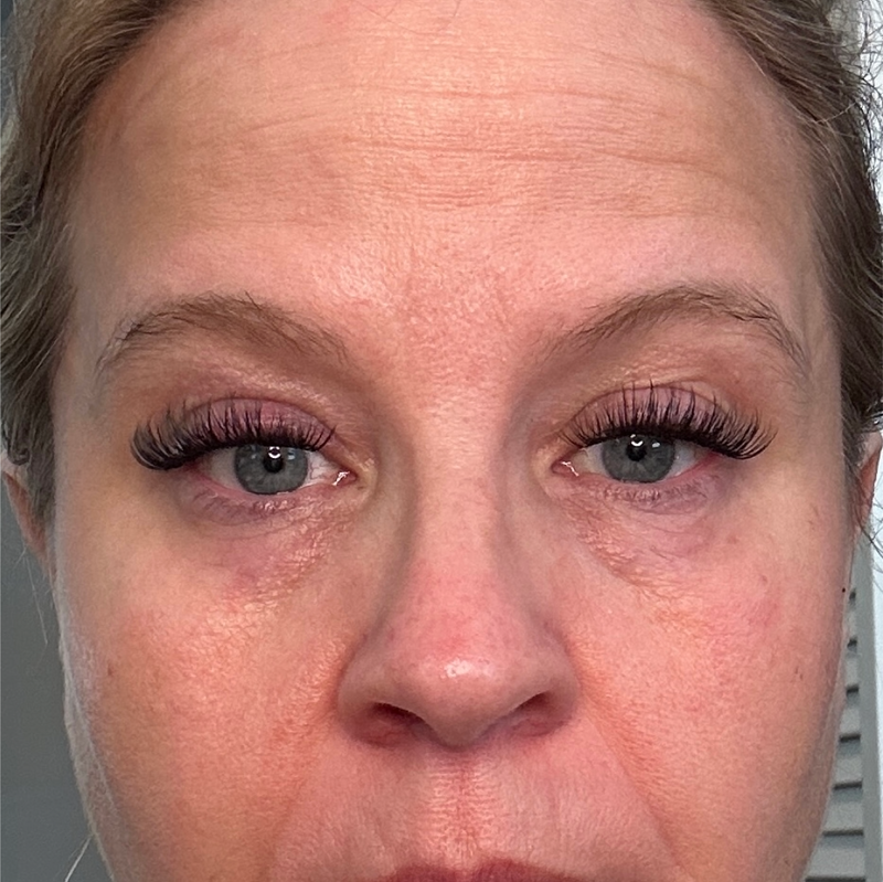 Before - Forehead + Under-Eye Area