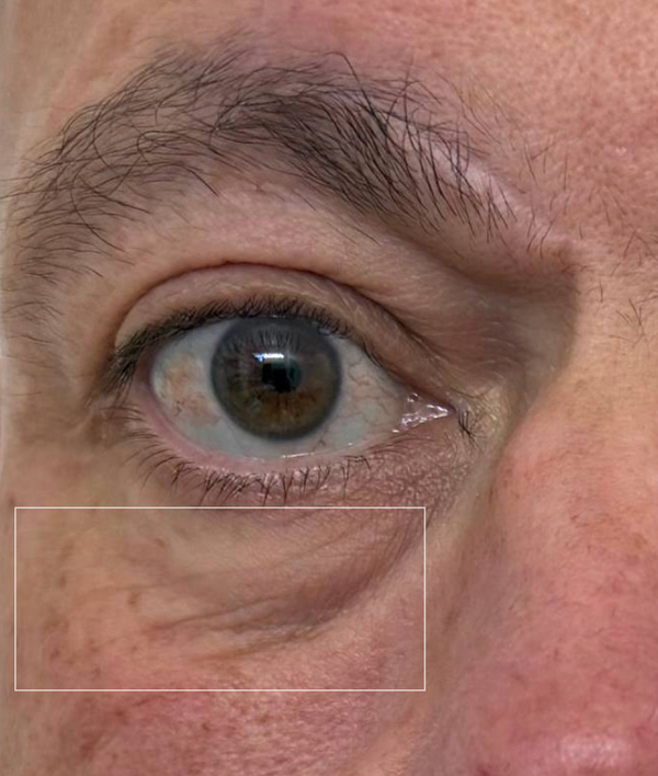 Before - Under-Eye Area