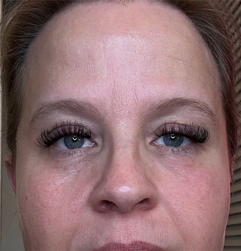 After - Forehead + Under-Eye Area