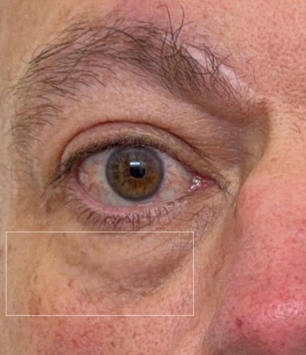 After - Under-Eye Area