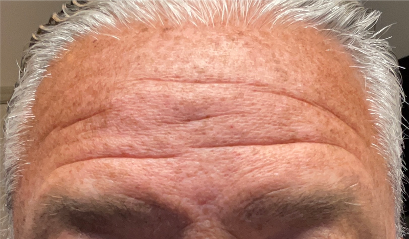Before - Forehead Area