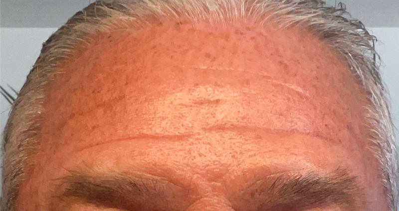 After - Forehead Area
