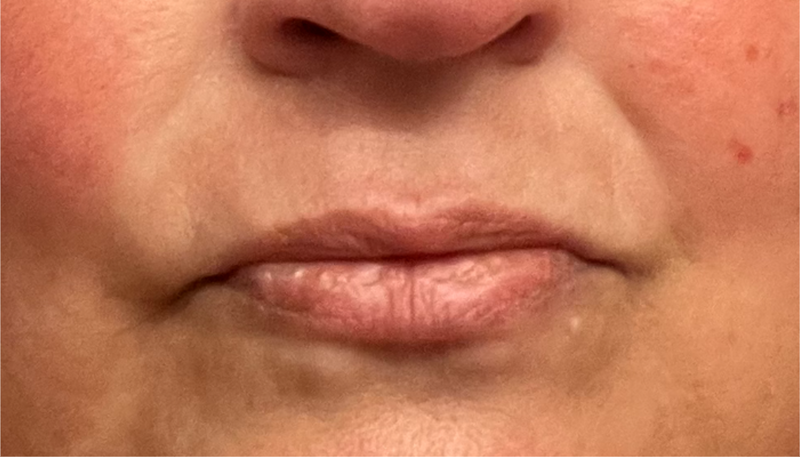 Before - Nasolabial Fold Area
