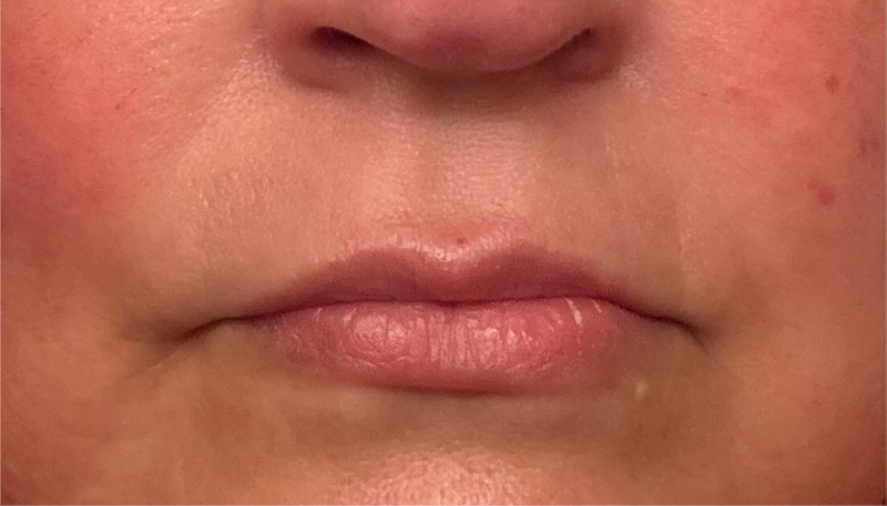 After - Nasolabial Fold Area