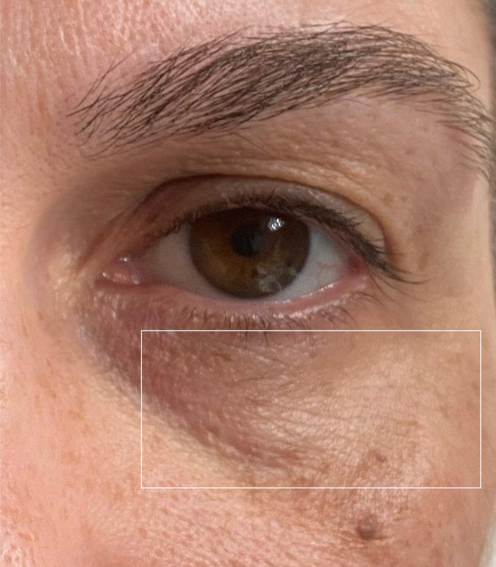 Under-eye area on day 30, after consistent use