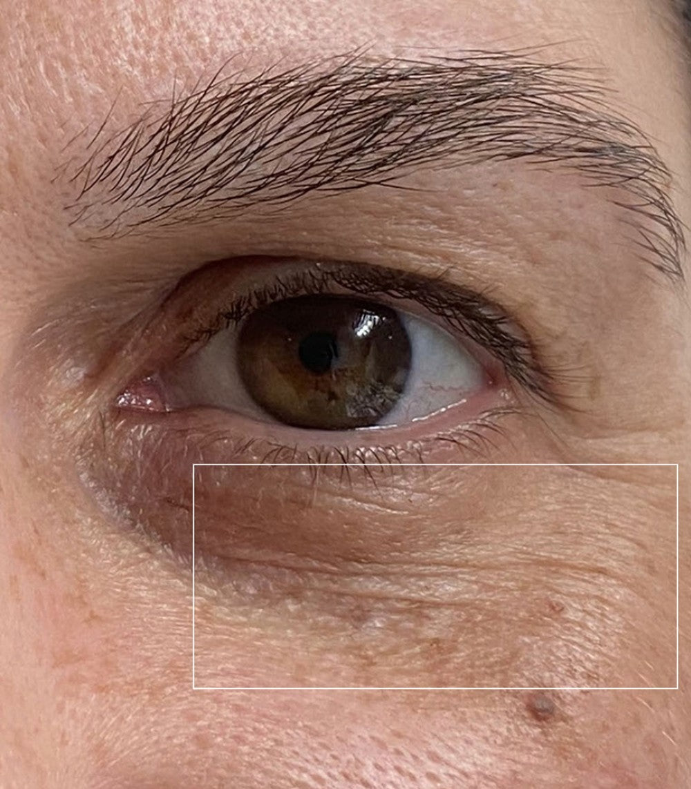 Under-eye area on day 1, before use