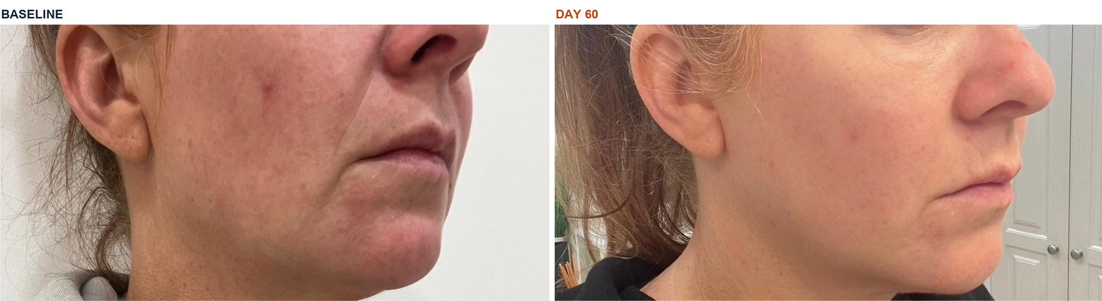 Jessica B. — Jaw and lower face · baseline and day 60
