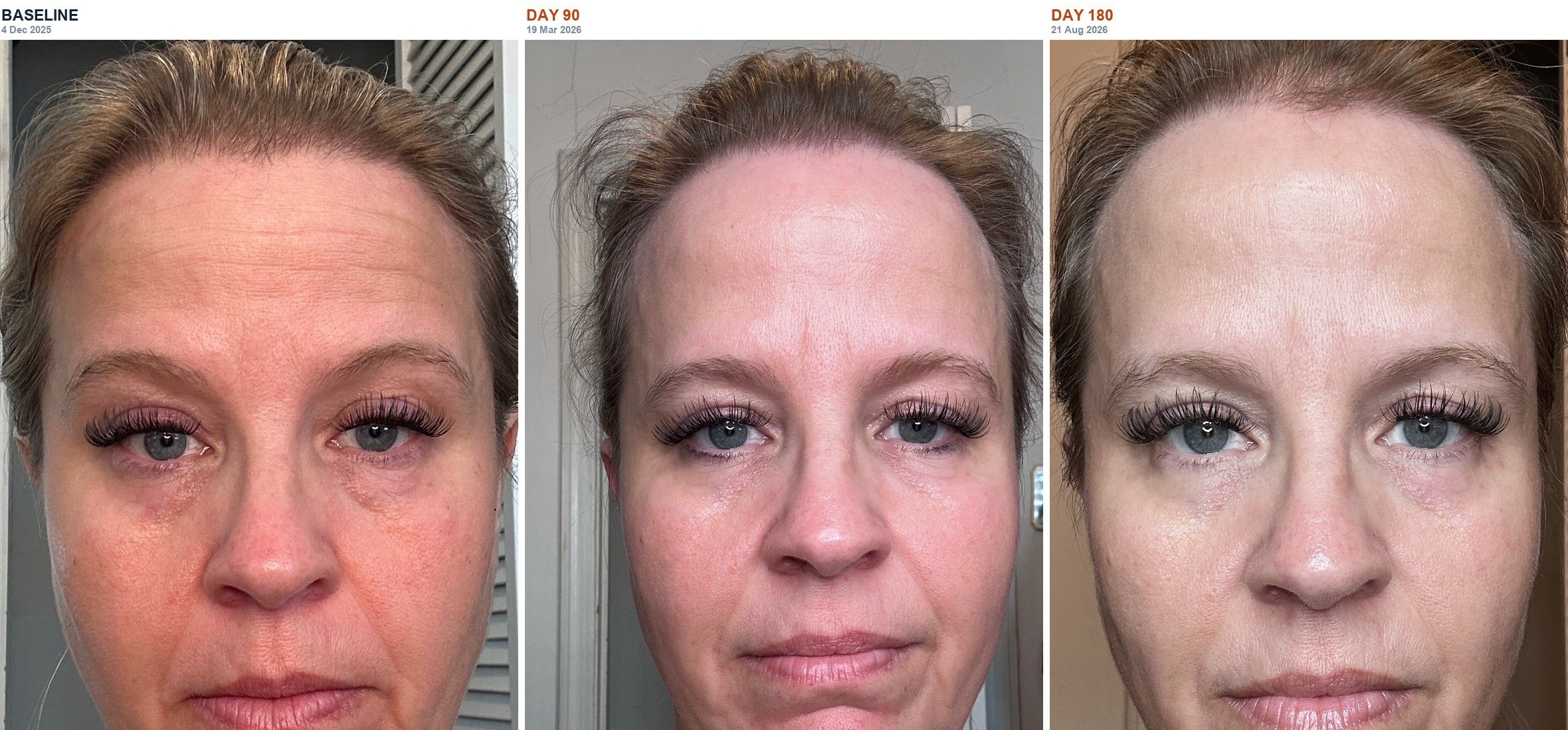 Participant 2 — Baseline, day 90 and day 180