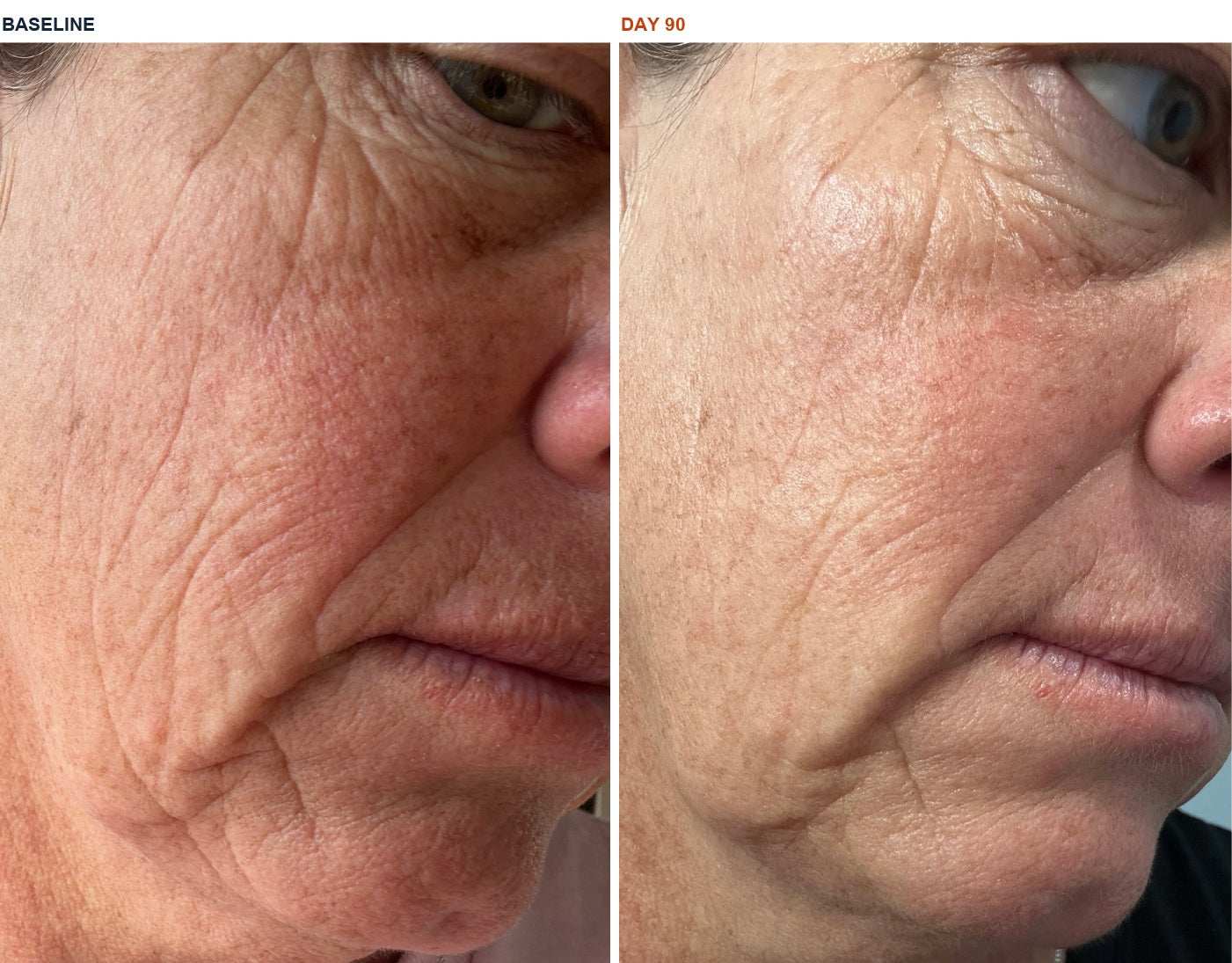 Gina G. — Cheek, nasolabial fold and marionette region · baseline and day 90