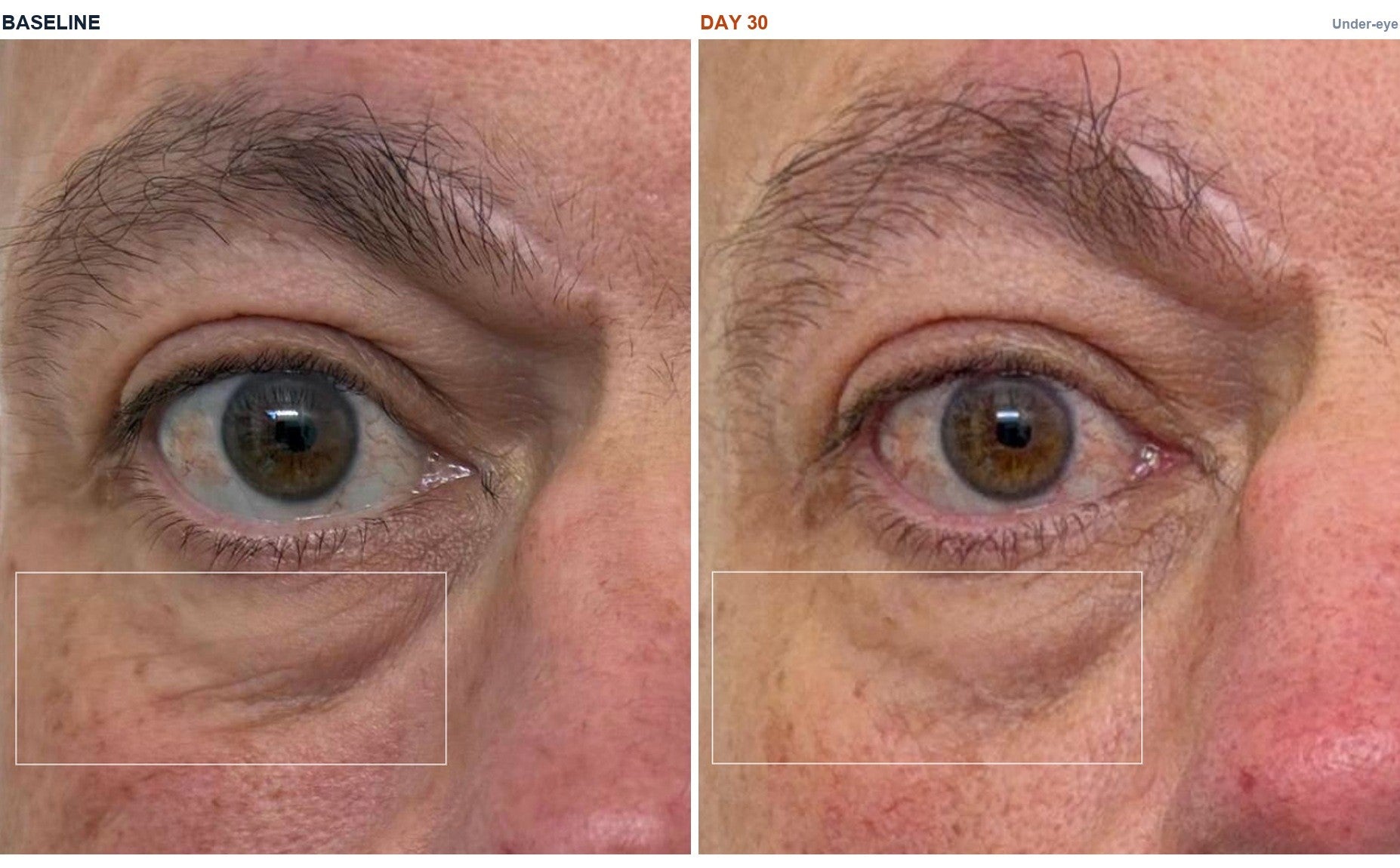 Michael M. — Under-eye and forehead · baseline and day 30